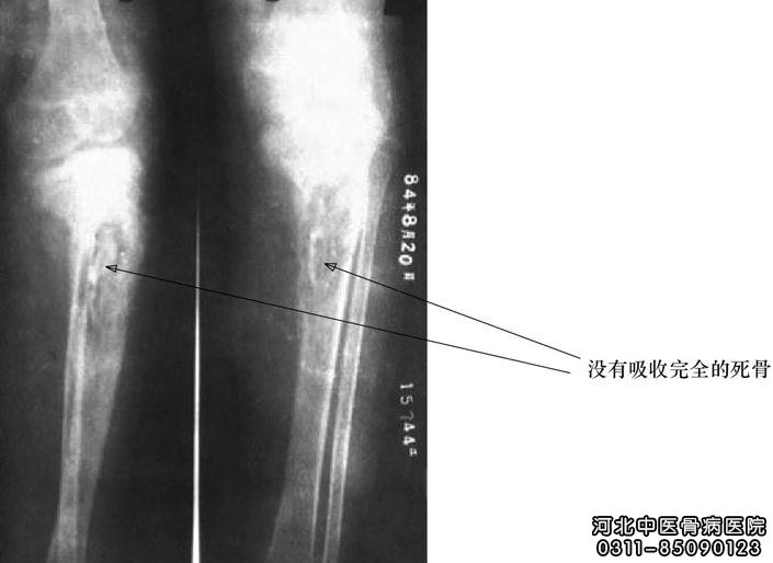 再治疗1个月骨轮廓形成.