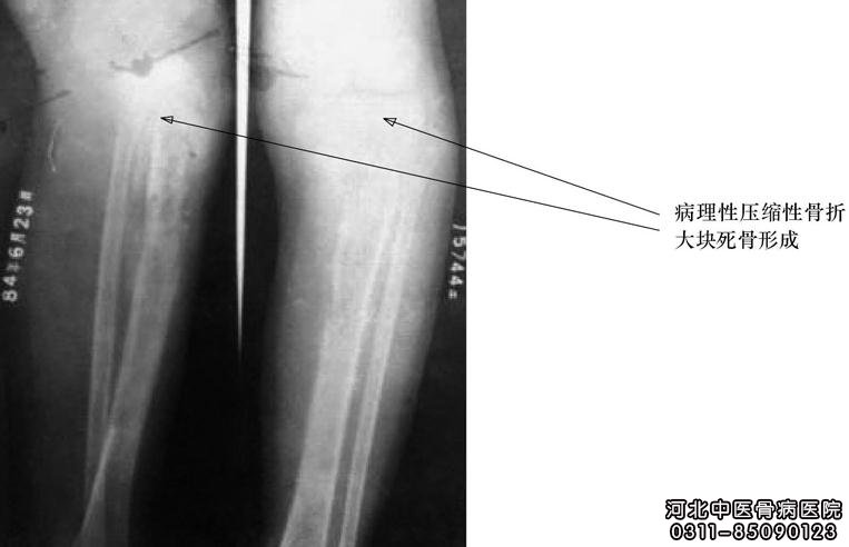 左胫腓骨慢性骨髓炎患者康复