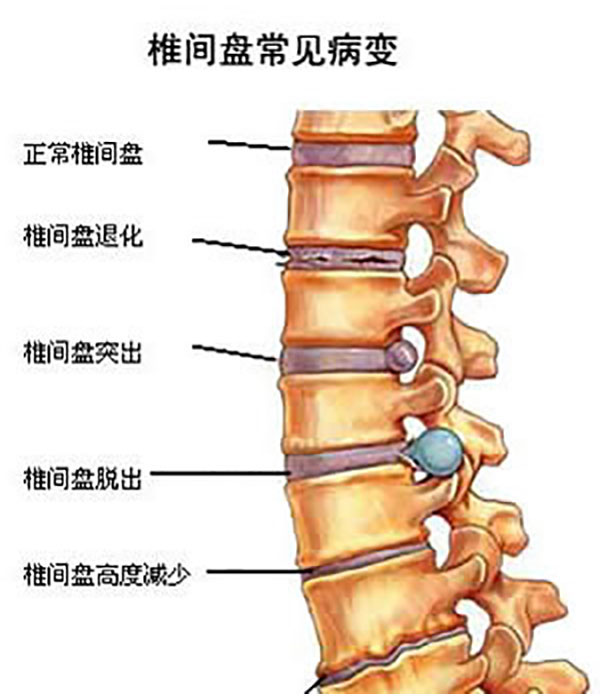 腰椎病压迫神经腿疼怎么治疗效果好