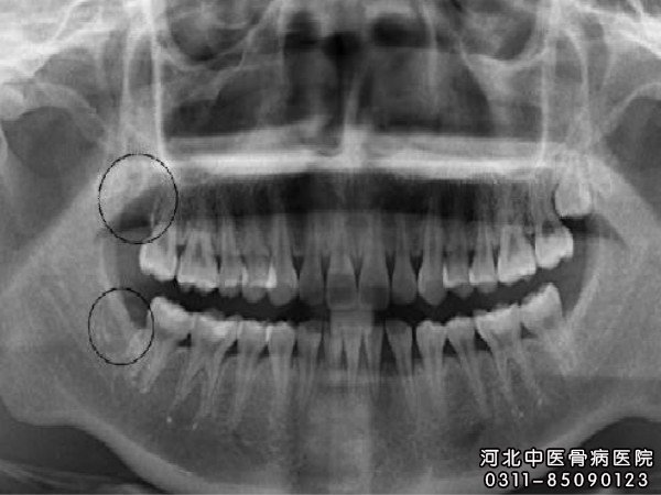 颌骨骨髓炎