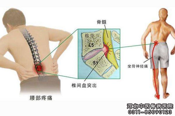 腰椎间盘突出