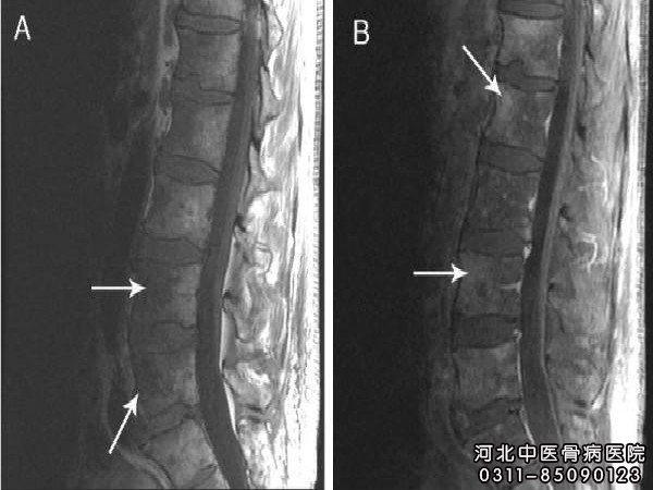 脊椎骨骨髓炎