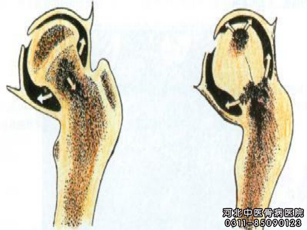 化脓性骨髓炎