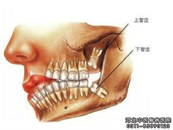 颌骨骨髓炎