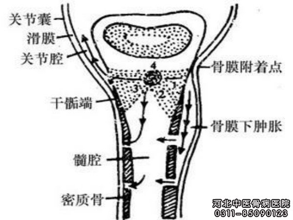 骨髓炎