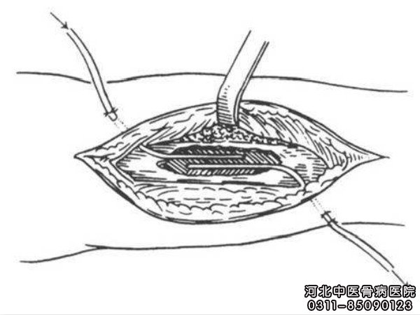 骨髓炎