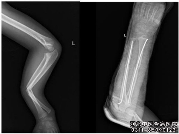 儿童骨不连患者的X片