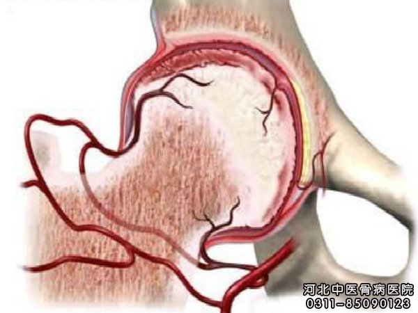股骨头坏死示意图